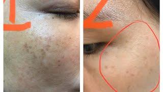Phân biệt nám tàn nhang và cách điều trị nám tàn nhang hiệu quả nhất tại tphcm | Da đẹp dáng xinh