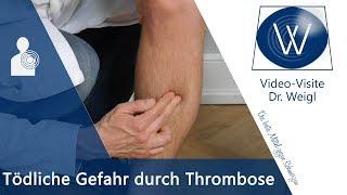 Die tödliche Gefahr durch Thrombose - Ursachen, Symptome & Tipps bei tiefer Beinvenenthrombose (TVT)