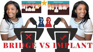 Dental Implants Vs Bridge. Watch Before getting a dental Implant or Bridge?