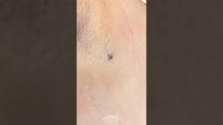 #shorts Big Underarm Blackhead Removal  (DPOW Extraction) | CONTOUR DERMATOLOGY