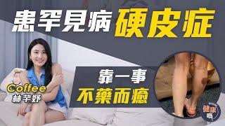 Coffee 林芊妤專訪（上）｜患硬皮症肌肉萎縮無藥可醫 放棄治療躺平竟痊愈？｜術後直踩21小時拍攝 傷口大出血入院｜走過鬼門關 悟健康真諦｜健康嗎‪@HealthCodeHK‬ 【醫檔案】