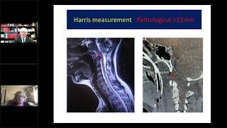 Craniocervical Instability in Hypermobile EDS - Jane R. Schubart, PhD & Fraser C. Henderson, Sr., MD