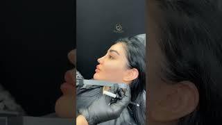 Cheek Contouring filler _  Botox ,,                     #shorts #cheekfiller #short #botoxtreatment