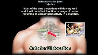 Sternoclavicular Joint Injuries - Everything You Need To Know - Dr. Nabil Ebraheim