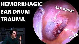 Blood Sac Found On Eardrum (Hearing Loss & Tinnitus)