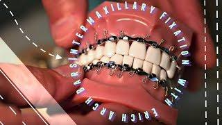 Intermaxillary Fixation with Erich Arch Bars