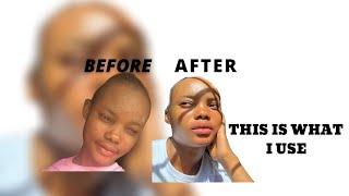 HOW I CLEARED MY ACNE. #skincare #akinolubukola