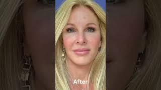 INCREDIBLE, JAW-DROPPING Facelift Transformations by Dr. Amir Karam!