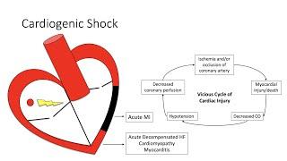 Cardiogenic Shock