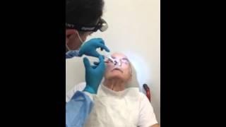 Regenestem Treatments: Intranasal Delivery Procedure