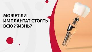 Срок службы зубных имплантов | Может ли имплант стоят всю жизнь?