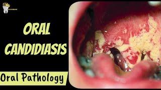 ORAL CANDIDIASIS | Diagnosis and Management | Oral Pathology