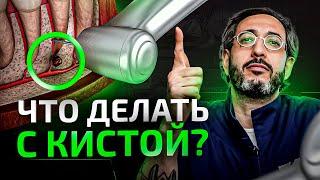 Киста зуба, что делать – лечить или удалять?