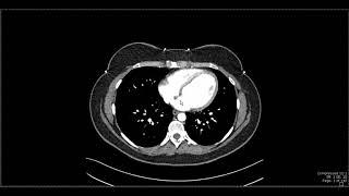 Abdominal Anatomy on Computed Tomography