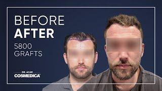 Hair Transplant in Turkey | Results | Dr. Acar | Cosmedica Clinic