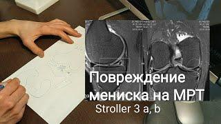 Повреждение мениска по МРТ 3а, 3б ( 3a, 3b ) степени по Stoller. Какая тактика лечения?