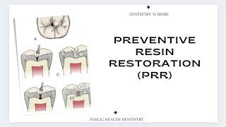 PRR(PREVENTIVE RESIN RESTORATION )