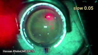 Capsulaser , New Technology of cataract Surgery