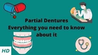 PARTIAL DENTURE: Everything you need to know about them