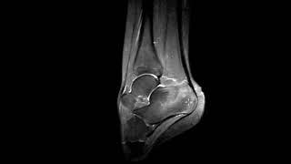 Calcaneal stress fracture