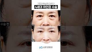 기존과 확실히 다르다!! 4세대 하안검 수술 4세대하안검 #하안검 #눈밑성형
