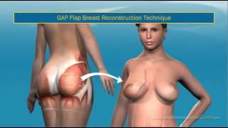 Breast Reconstruction Techniques