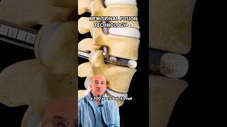 High-Tech Spinal Fusion for Back Pain Relief⁉️ #shorts
