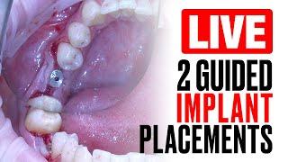 LIVE Guided Dental Implant Surgery