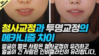 철사 치아교정 vs 인비절라인 투명교정의 메카니즘 차이에 의한 힘