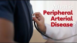 What is PAD? The facts on peripheral artery disease.