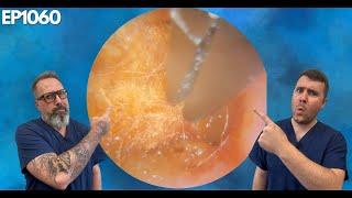 Q-TIP STUCK IN EAR - PATIENT HAD NO IDEA - EP1060