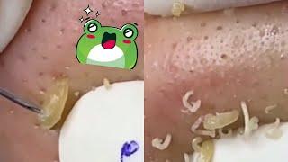 Ultimate Blackhead Extraction: Satisfying Pimple Popping