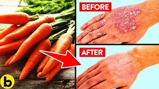 14 Foods That Are Great For Fighting Your Psoriasis