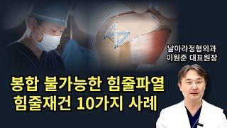 어깨 회전근개파열 봉합 불가능할때 선택하는 상부관절막재건술
