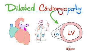 Dilated (Congestive) Cardiomyopathy (Systolic Dysfunction) - Causes, Symptoms, Diagnosis, Treatment