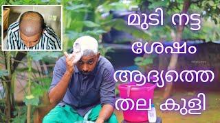 First Head Wash After hair transplantation | എന്റെ തല കുളി | safvan pullara |