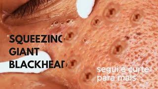 Como vencer cravos e espinhas inflamadas (Cleansing & Ingrown Hair Solutions)