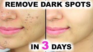 In 3 DAYS - Remove DARK SPOTS, BLACK SPOTS & ACNE SCARS | Anaysa