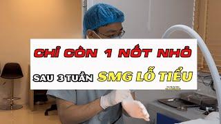 Tái Khám Sùi Mào Gà Lỗ Tiểu | Bs Sắc nam học Bv Việt Đức