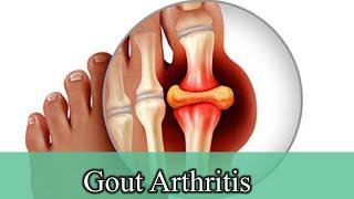 Gout Arthritis (Part 1) | House Physiotherapy