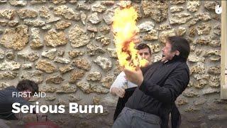 Learn first aid gestures: Serious Burn