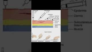 #Image based question # Injection site with AngleRepeated NORCET 2021 #AIIMS#Target NORCET 2022