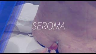 Seroma postcirugía