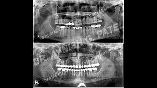 Step by step full mouth rehabilitation