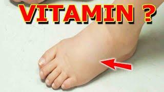 VITAMIN TỐT NHẤT để LOẠI BỎ Bệnh SƯNG PHÙ CHÂN - 2 LOẠI TRÀ TỐT NHẤT CHO CHỨNG SƯNG VIÊM