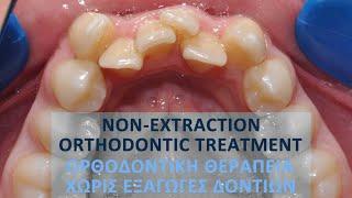 Non-extraction orthodontic treatment (Pt B.E.)