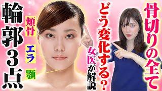 【輪郭骨切り整形】小顔にするには輪郭３点するべき？女医が解説！