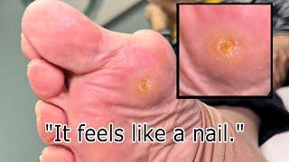 This Foot Corn Feels Like a Nail! ️ How to Treat Deep Foot Corns and Painful Pressure Points