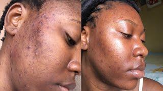 the ORDINARY niacinamide 10% + zinc 1% serum review with (before and after) results