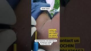 #shorts #shortvideo #drvarunnambiar #cosmetology Skin Tag Removal Treatment